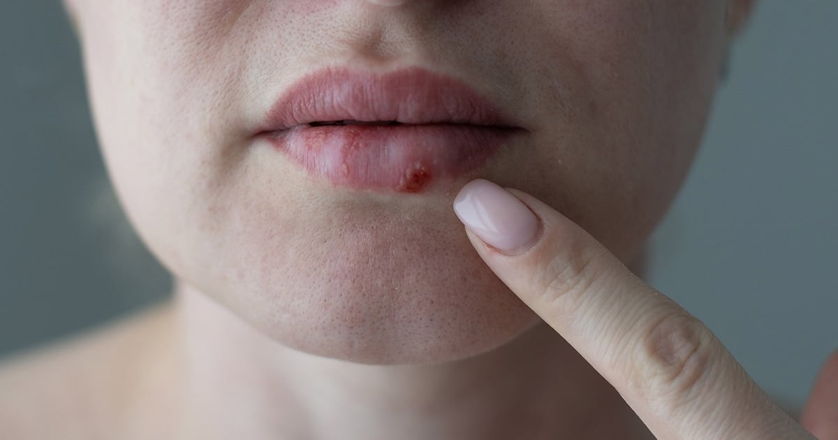 Casi tres décadas sin respuestas y unApproval que cambia el mapa para los pacientes con herpes resistente